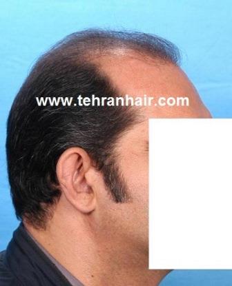 how to regrow hair naturally in hindi